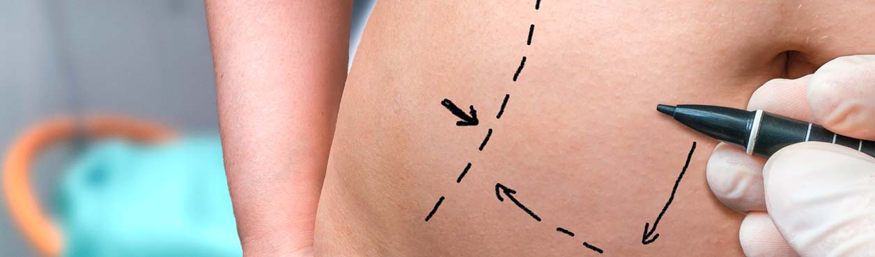 Fettaubsaugung Berlin